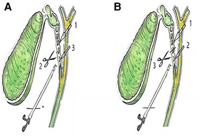 "Semicut” skill on the cystic duct in laparoscopic cholecystectomy